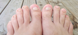 Гъбички на ноктите на краката