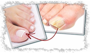 Причините за гъбички на ноктите