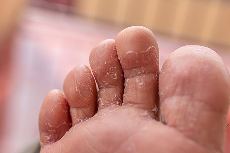 гъбички на кожата на пръстите - начален етап