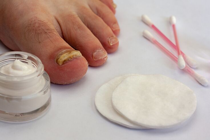 лечение на гъбички на пръстите на краката с крем от гъбички