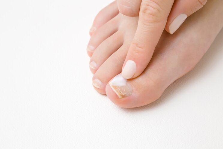 лечение на пръстите на краката с мехлем за гъбички