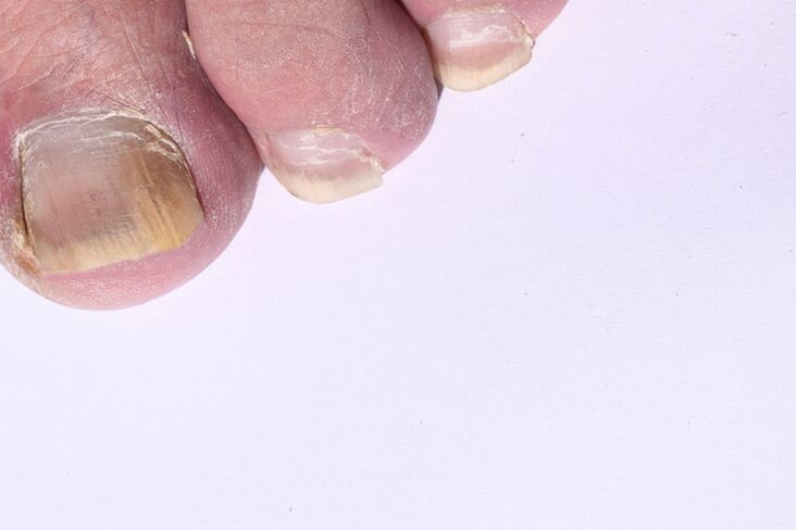 началният стадий на микоза на ноктите на краката