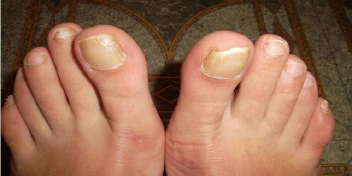 как изглежда гъбичките на ноктите на краката