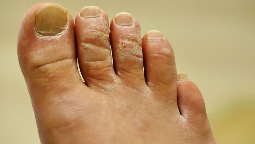сквамозна гъбичка на ноктите на краката