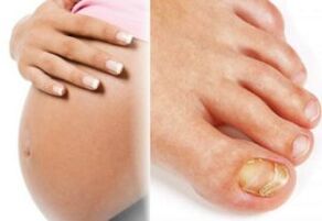 Бременност и гъбички по ноктите на краката