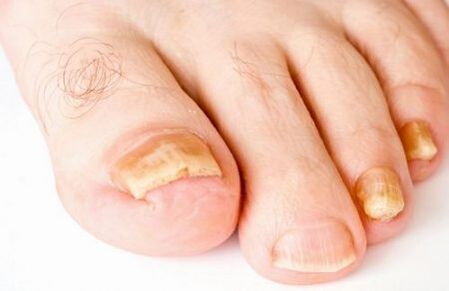 пожълтяване на ноктите на краката с гъбички