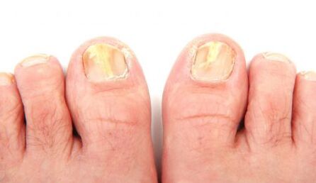 прояви на гъбички на ноктите на краката