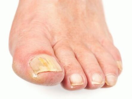 увреждане на ноктите с гъбички по краката