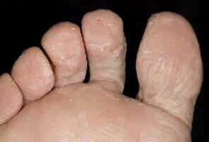 симптоми на гъбички по кожата на краката