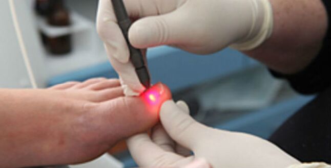 Лазерна терапия за гъбички по ноктите на краката