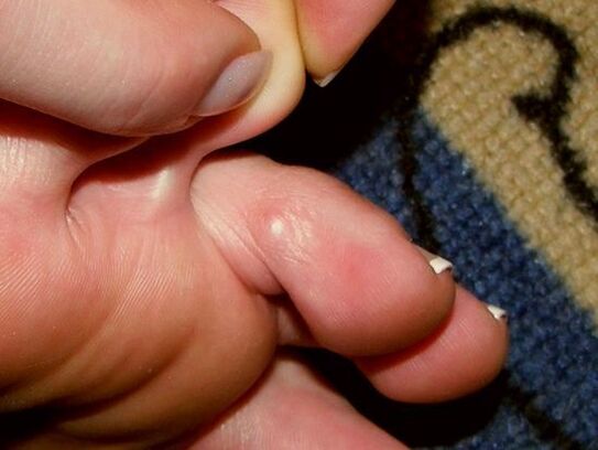 симптоми на гъбички на пръстите на краката