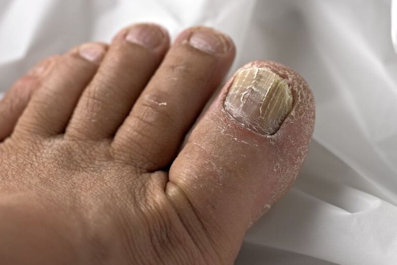 Гъбички по ноктите на краката