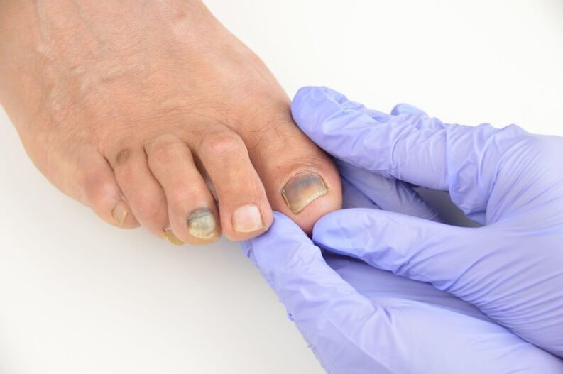 Медицински преглед на ноктите на краката, засегнати от гъбички
