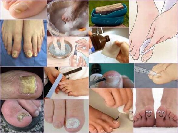 гъбички по ноктите на краката и лечението им с лак