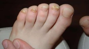 Гъбички изумени от почти всички пръсти на краката