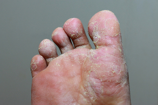 Тежка етап на микоза на кожата на пръстите на краката